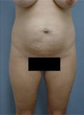 Patient # 61877 Before Photo # 1