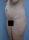 Patient # 61877 Before Photo # 3