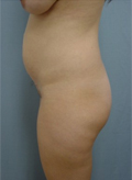 Patient # 61877 Before Photo # 5