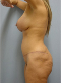 Patient # 59715 After Photo # 6