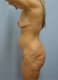 Patient # 59715 Before Photo # 5