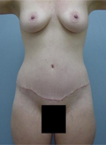 Patient # 70538 After Photo # 2