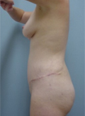 Patient # 70538 After Photo # 6