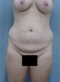 Patient # 70538 Before Photo # 1