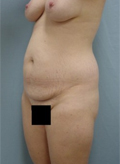 Patient # 70538 Before Photo # 3