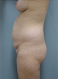 Patient # 70538 Before Photo # 5