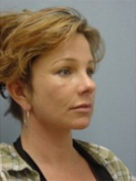 Patient # 52658 After Photo # 4