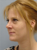 Patient # 42344 After Photo # 4