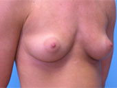 Patient # 59821 Before Photo # 3
