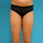 Patient # 16533 After Photo # 4