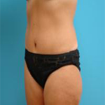 Patient # 81250 After Photo # 4