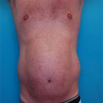 Patient # 42659 Before Photo # 3