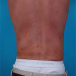 Patient # 97411 After Photo # 2