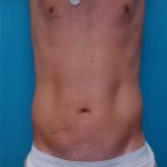 Patient # 97411 After Photo # 4