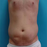 Patient # 97411 Before Photo # 3