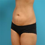 Patient # 35041 After Photo # 2
