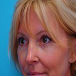 Patient # 74822 After Photo # 4