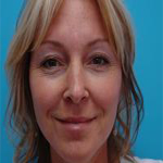Patient # 74822 Before Photo # 1