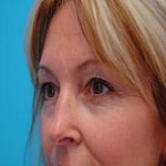 Patient # 74822 Before Photo # 3