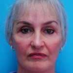 Patient # 64398 After Photo # 2