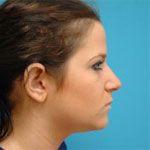 Patient # 35644 Before Photo # 1