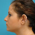 Patient # 35644 Before Photo # 3