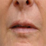 Patient # 33576 Before Photo # 1