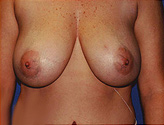 Patient # 95304 Before Photo # 1