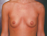 Patient # 59556 Before Photo # 1