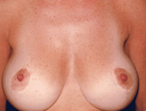 Patient # 45056 After Photo # 2