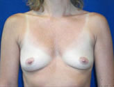 Patient # 81108 Before Photo # 1