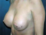 Patient # 30896 After Photo # 2