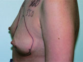 Patient # 30896 Before Photo # 1