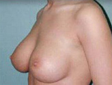 Patient # 62078 After Photo # 2