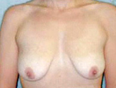 Patient # 31342 Before Photo # 1