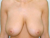 Patient # 25125 Before Photo # 1