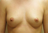 Patient # 51596 Before Photo # 1