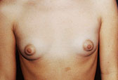 Patient # 38784 Before Photo # 1