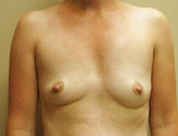 Patient # 61277 Before Photo # 1