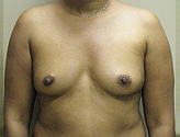 Patient # 28359 Before Photo # 1