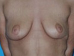 Patient # 84146 After Photo # 2