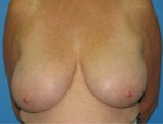 Patient # 86499 Before Photo # 1