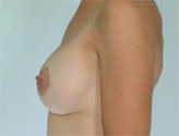 Patient # 68882 After Photo # 6