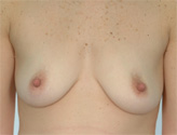 Patient # 68882 Before Photo # 1