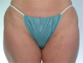 Patient # 10871 Before Photo # 1