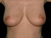 Patient # 37484 After Photo # 2