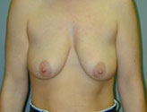 Patient # 71684 Before Photo # 1