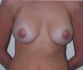 Patient # 40724 After Photo # 2