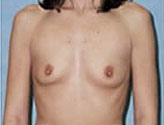 Patient # 38056 Before Photo # 1