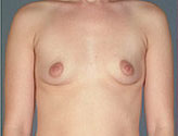 Patient # 45440 Before Photo # 1